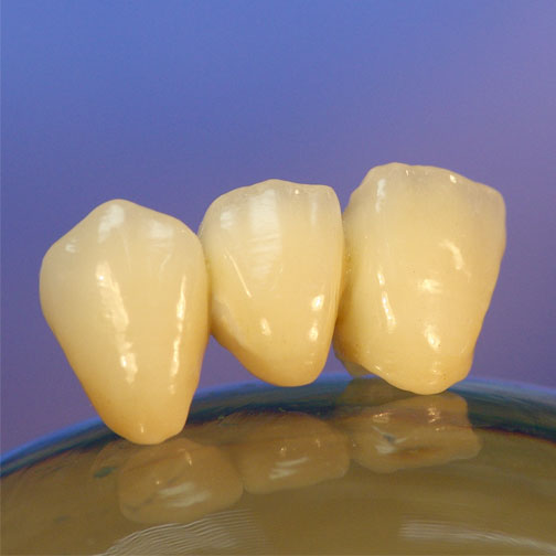 Galvanobrücke Zikonoxidkronen