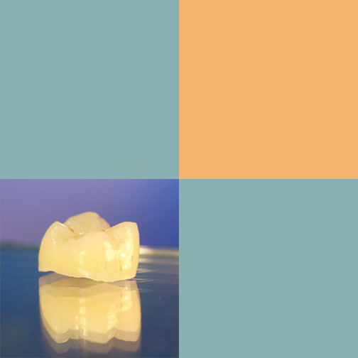 Galvanobrücke Zikonoxidkronen